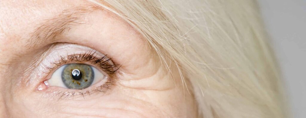 BLEFAROPLASTIA