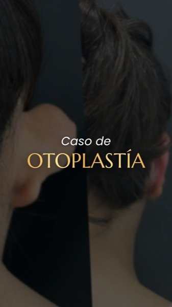 Caso de Orejas Prominentes