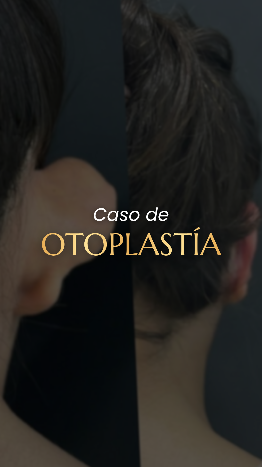 Caso de Orejas Prominentes